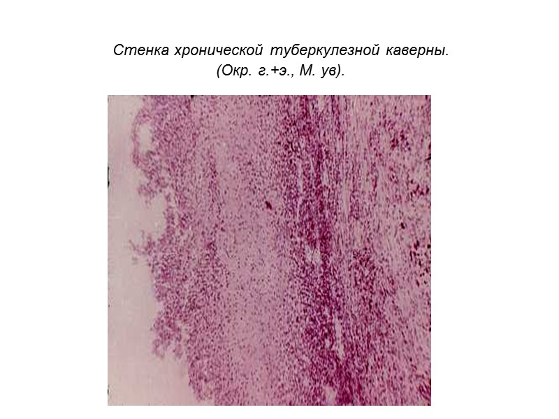 Стенка хронической туберкулезной каверны.  (Окр. г.+э., М. ув).
